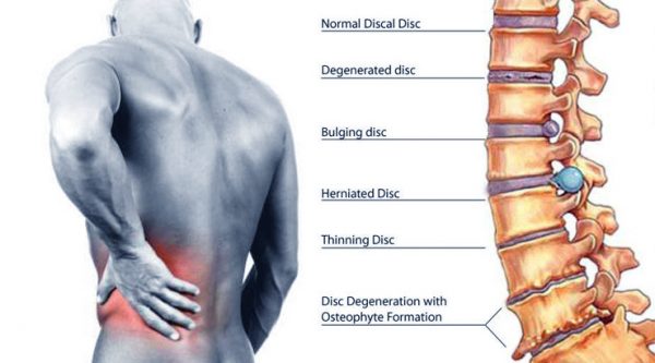 disc-herniation-louisville-lexington-aptiva-health