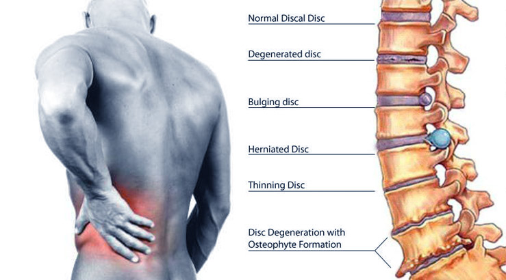 Herniated Disc Dallas  Slipped Disc Injury Southlake